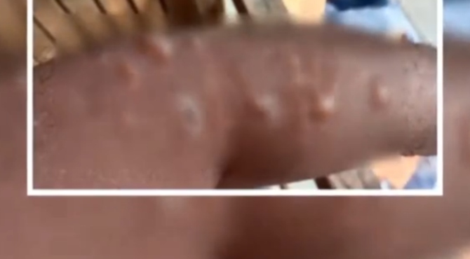 താനൂരില്‍ യുവാവിന് സൂര്യാതപമേറ്റു