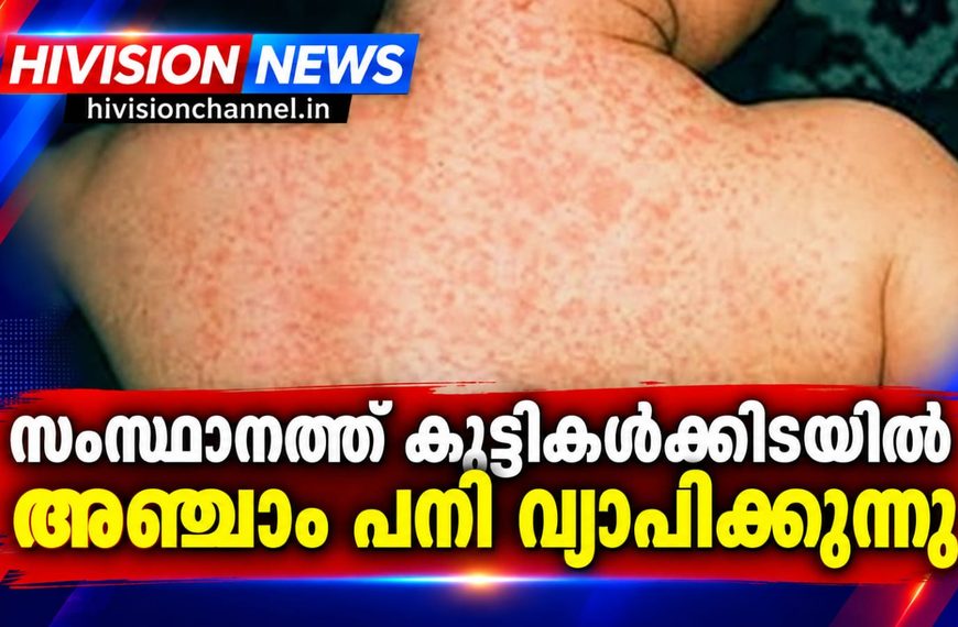 സംസ്ഥാനത്ത് കുട്ടികള്‍ക്കിടയില്‍ അഞ്ചാം പനി വ്യാപിക്കുന്നു